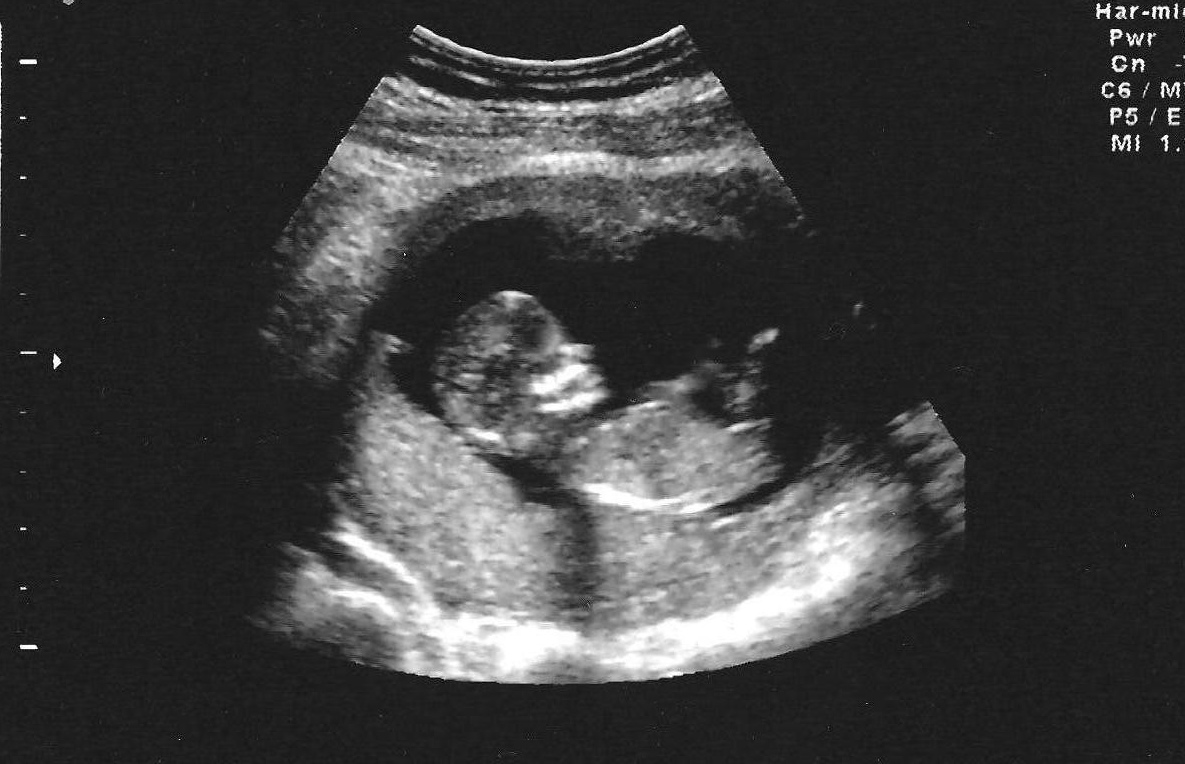 Ultrasound Pictures 30